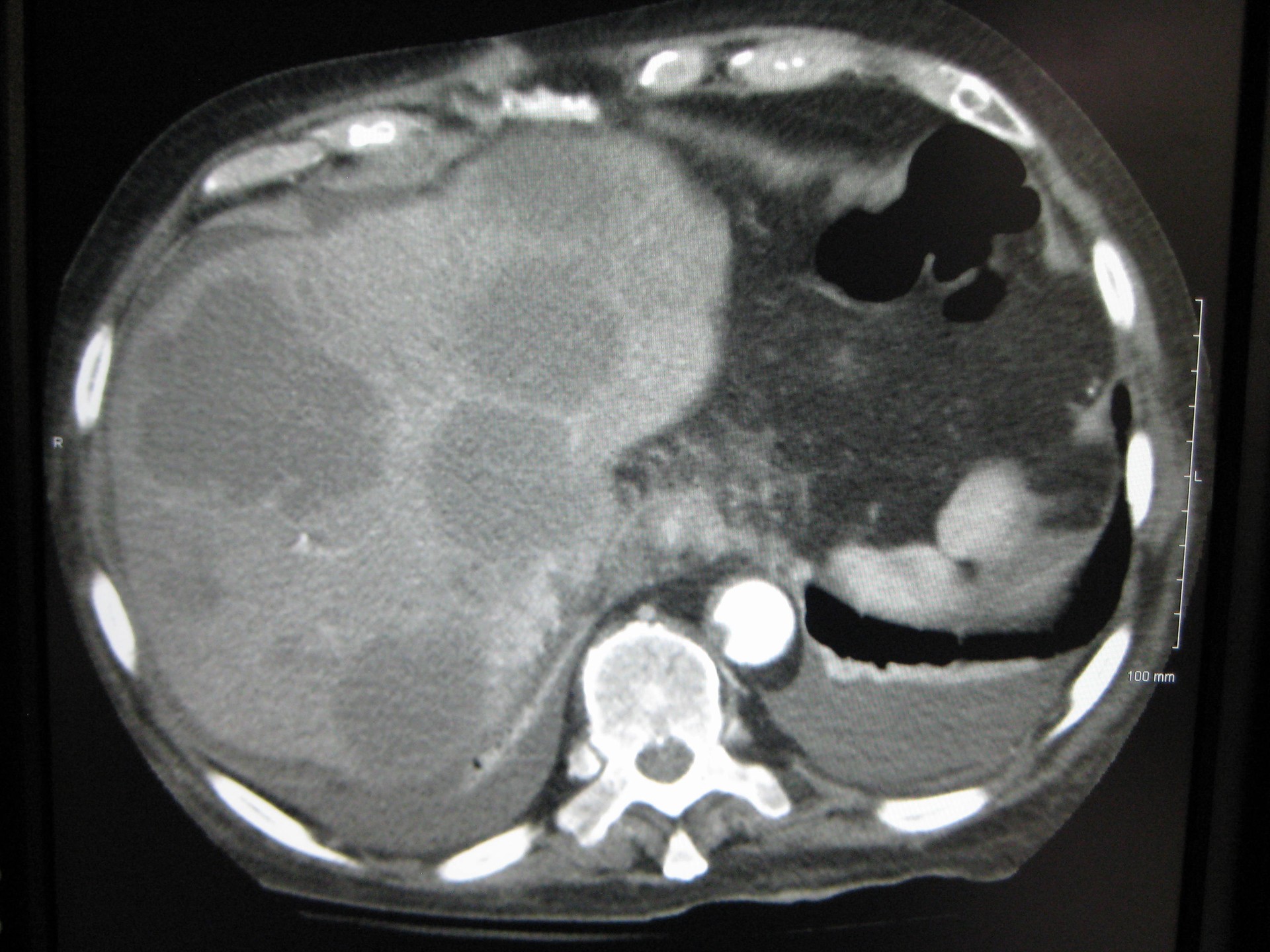 Ressonância mostra câncer de fígado (Foto: wikimedia commons)