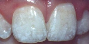 teeth-fluorosis