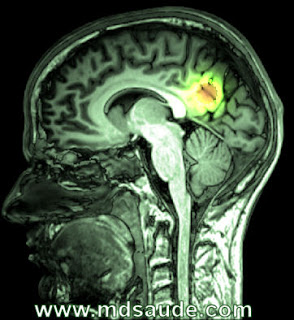 Tumor no cérebro