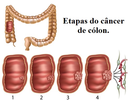 Cancer-de-colon