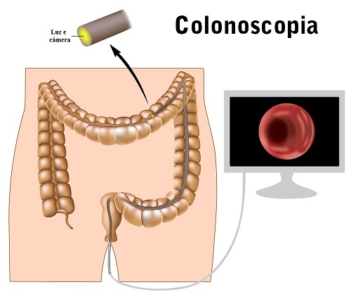 Colonoscopia