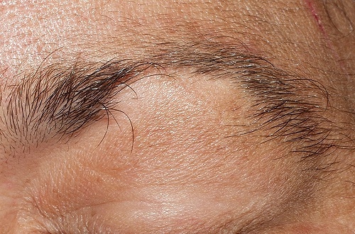 Alopecia em sobrancelhas e cílios: que tratamento seguir?