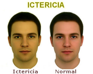 ictericia