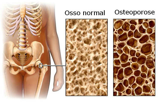 Osteosporose