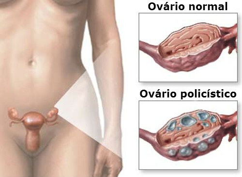 Tratamento natural para a Síndrome do Ovário Policístico