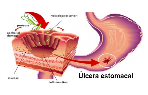 Tratamentos naturais para combater a Helicobacter Pylori