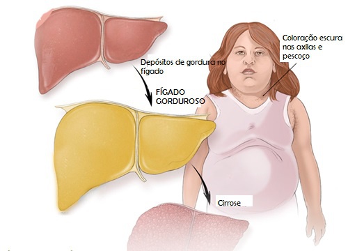 Frutas adequadas para tratar o fígado gorduroso