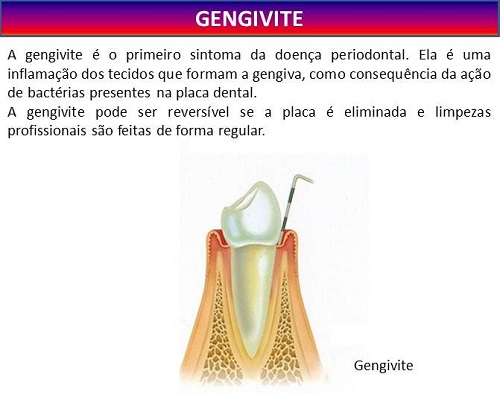 gengivite2