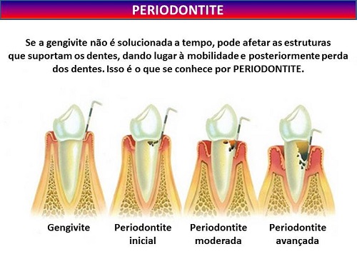 gengivite1